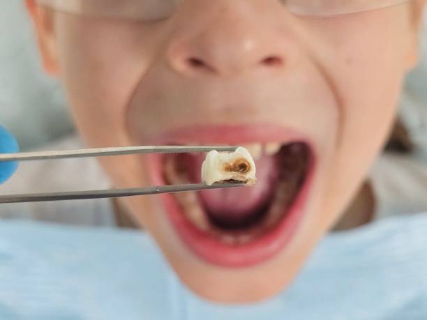 Best Knocked-Out Tooth Emergency  in Dania Beach, FL